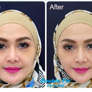 Before and after thread lift procedure