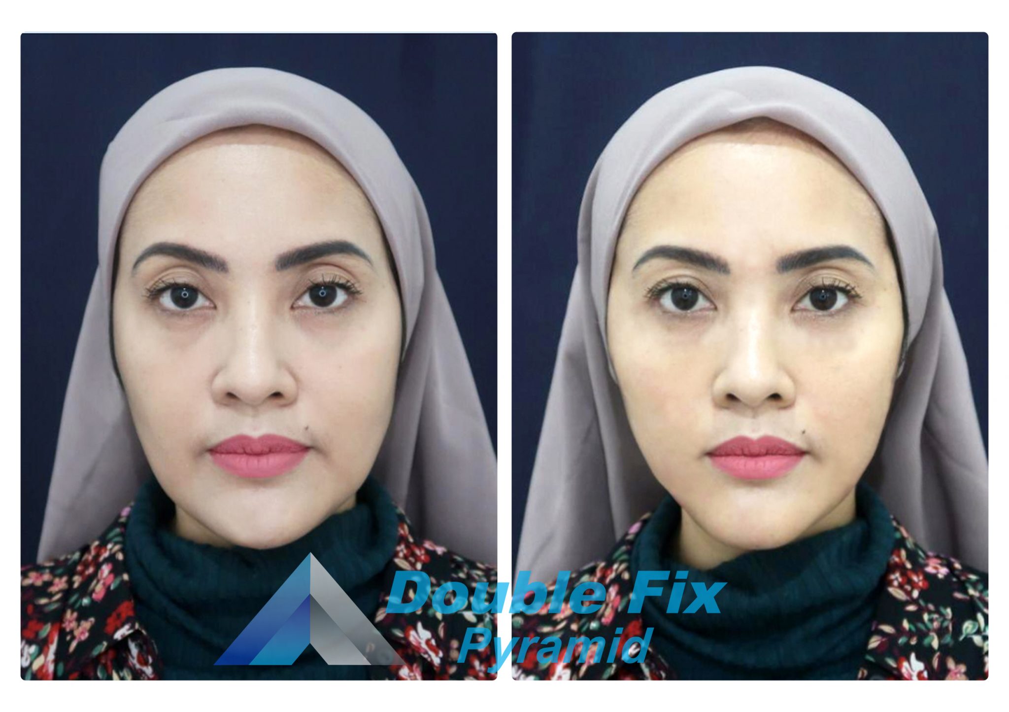 a woman after doing thread lift treatment with double fix pyramid thread