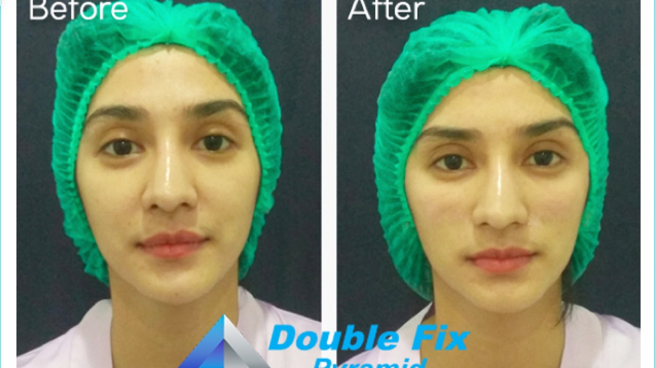 fanny ghasani after tired face removal with double fix thread
