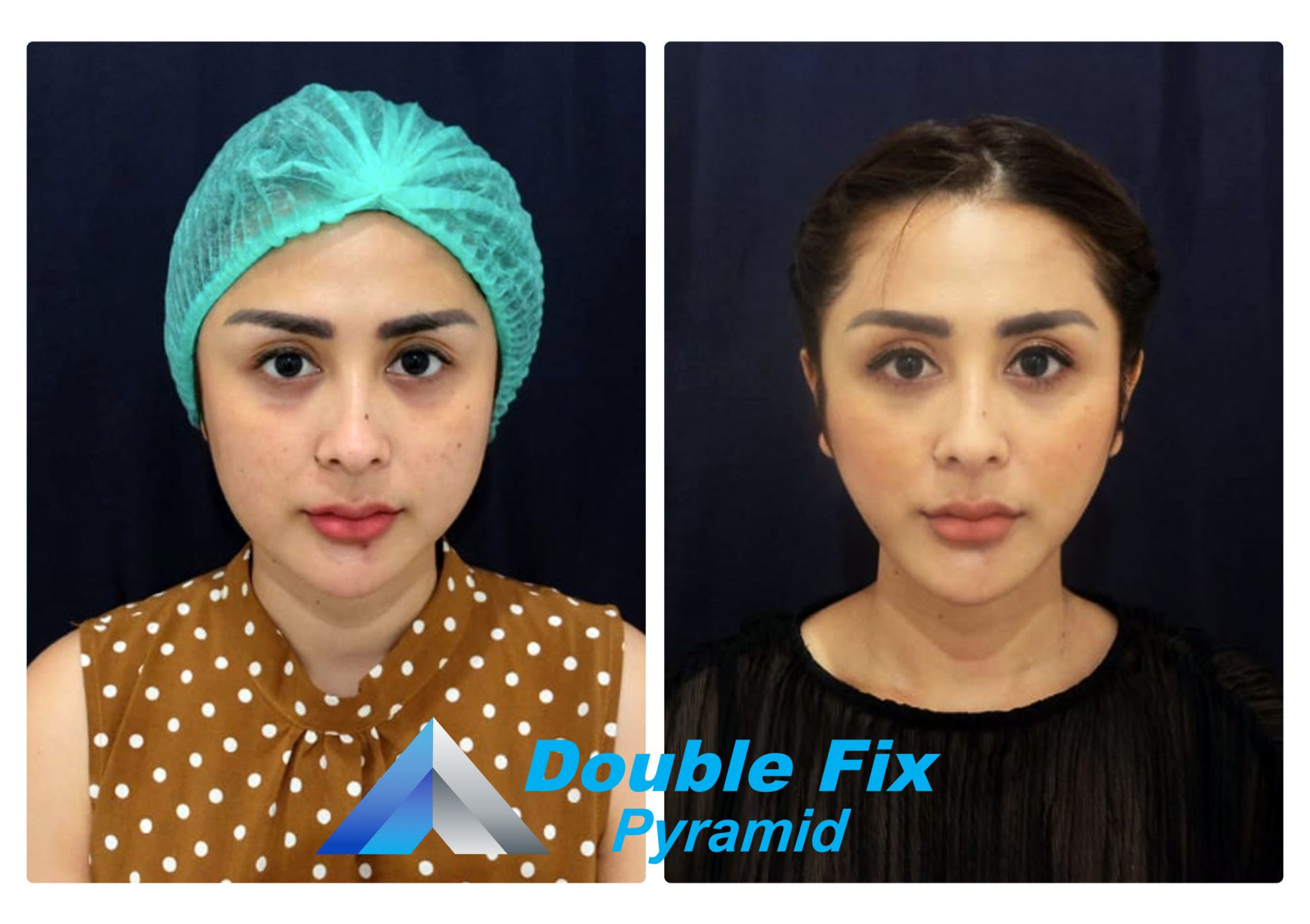 Before and after thread lift treatment