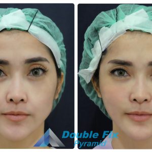 Before and after face thread lift procedure