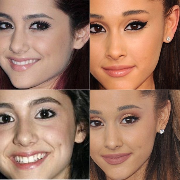 Ariana Grande after doing face lifting
