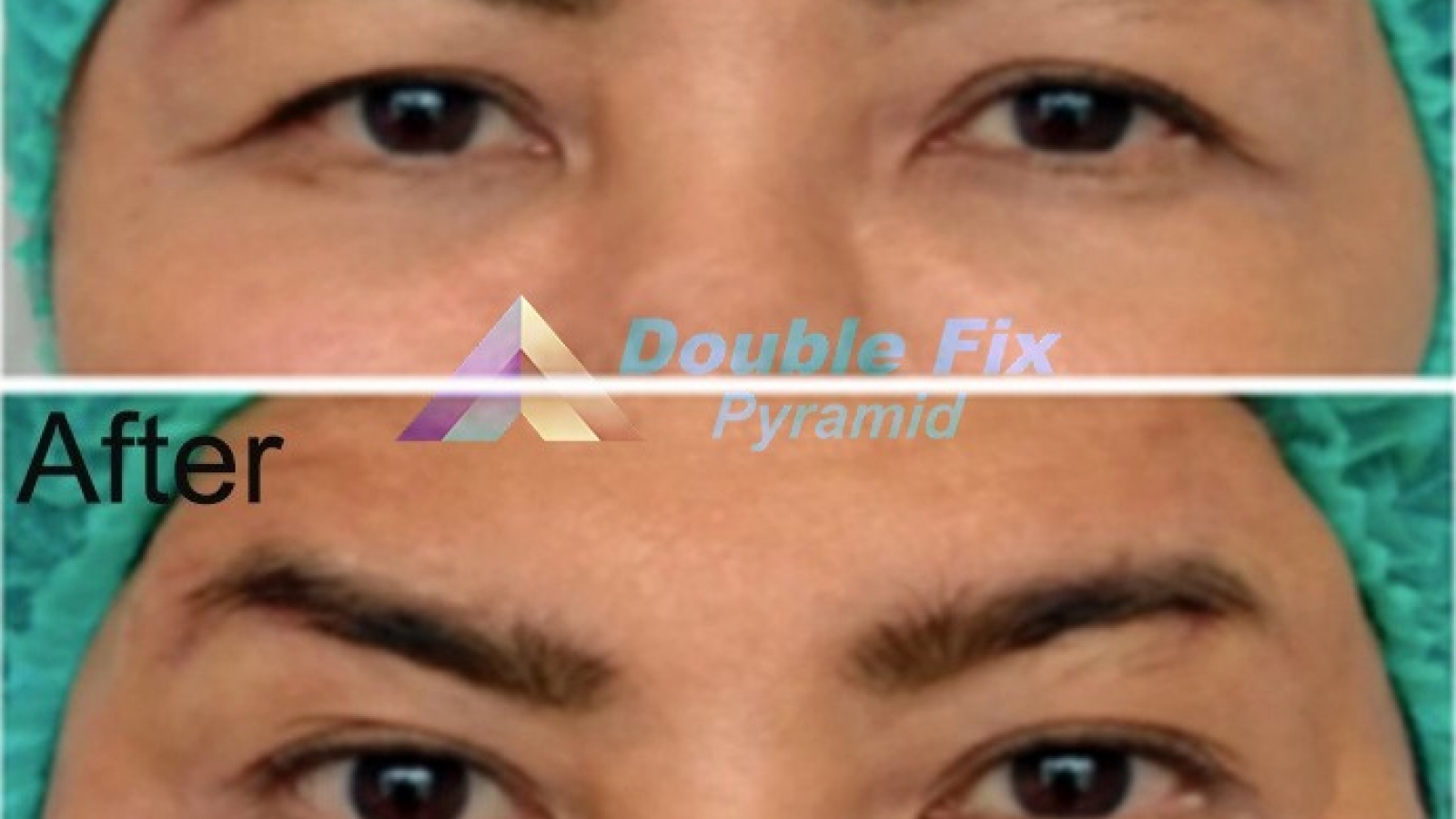 before and after overcoming eyebrow ptosis with facial threads