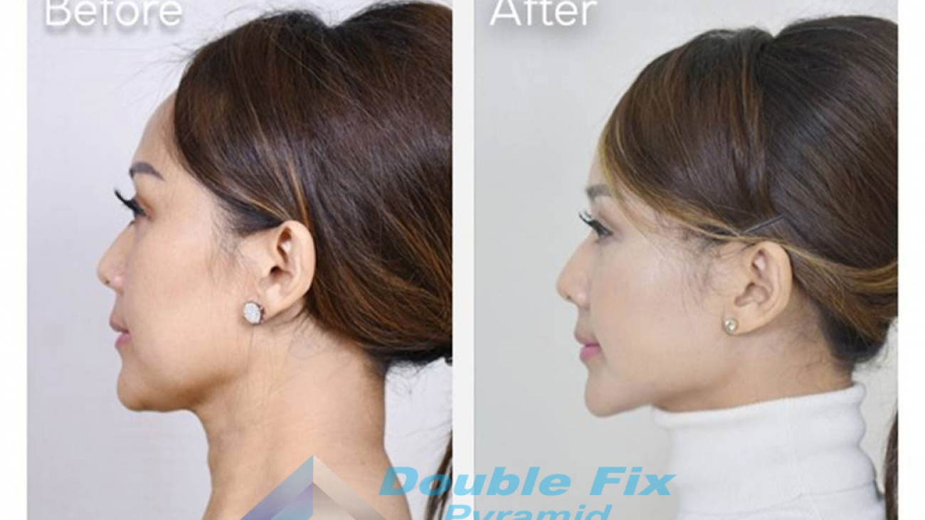 before and after double chin correction