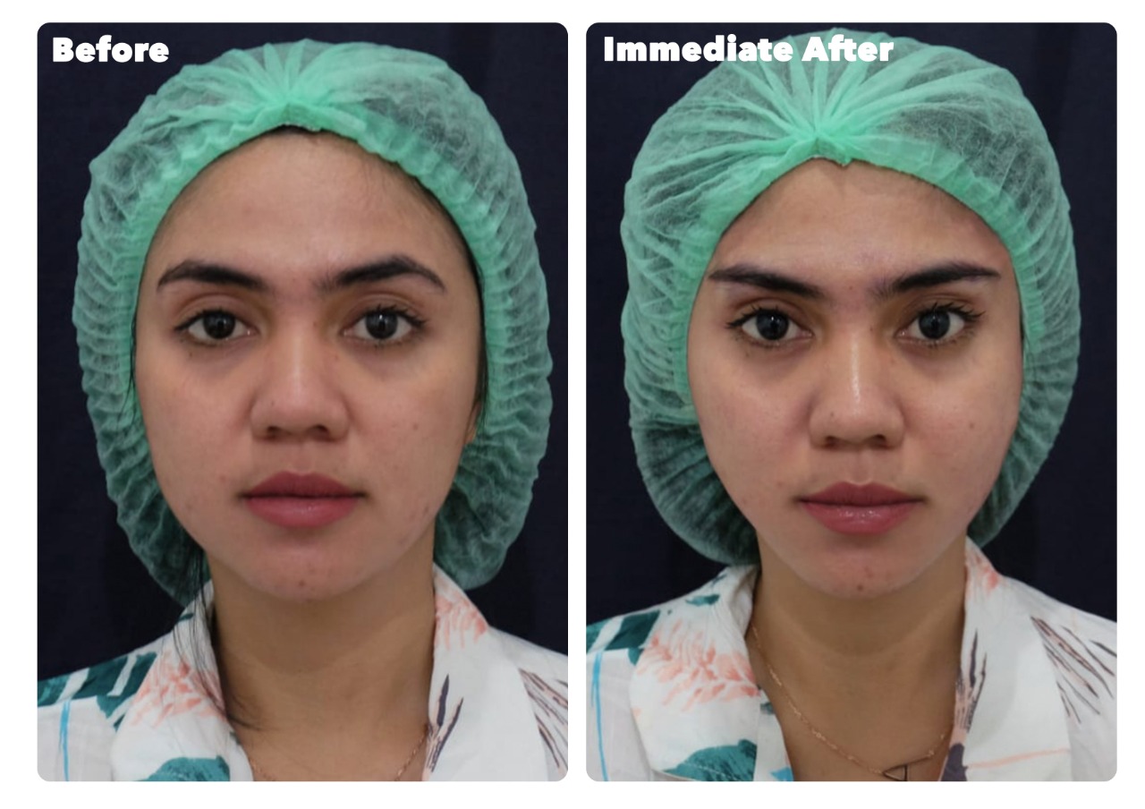 before and after eyebrow lifting with double fix pyramid