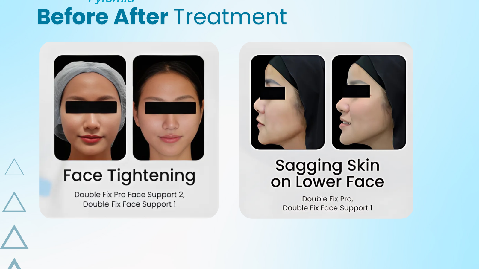 Hasil treatment menggunakan benang thread lift Double Fix Pyramid dengan teknologi canggih untuk hasil natural dan tahan lama