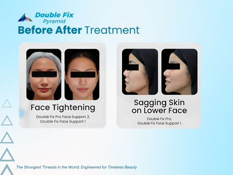 Hasil treatment menggunakan benang thread lift Double Fix Pyramid dengan teknologi canggih untuk hasil natural dan tahan lama