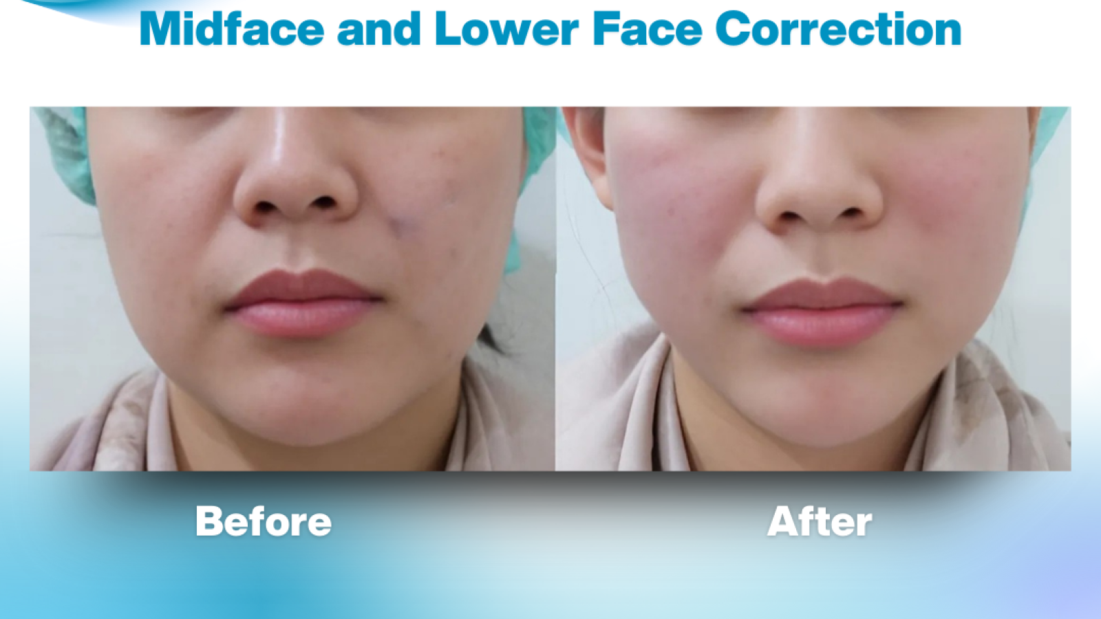 Midface and lower face correction