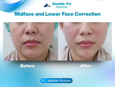 Midface and lower face correction