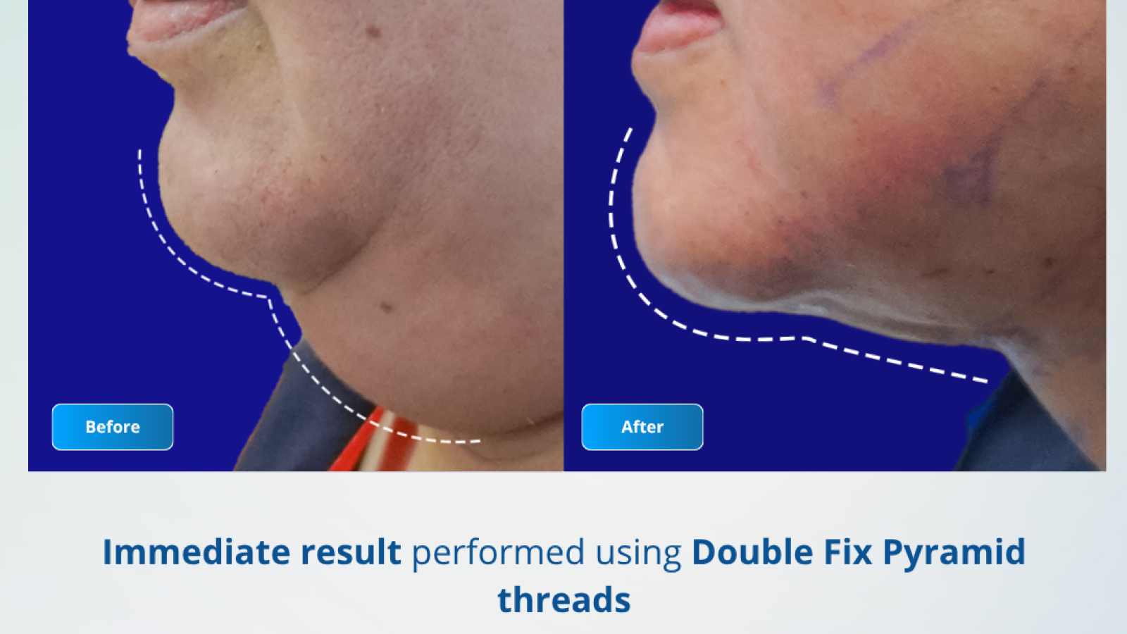 Before After - Perdesti 7 - 8 Februari 2026 (2)