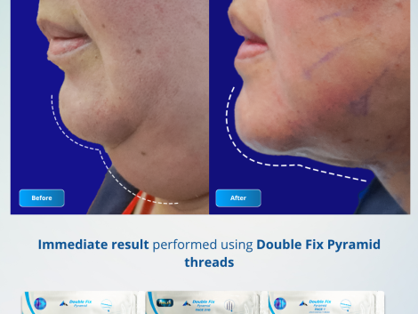 Before After - Perdesti 7 - 8 Februari 2026 (2)