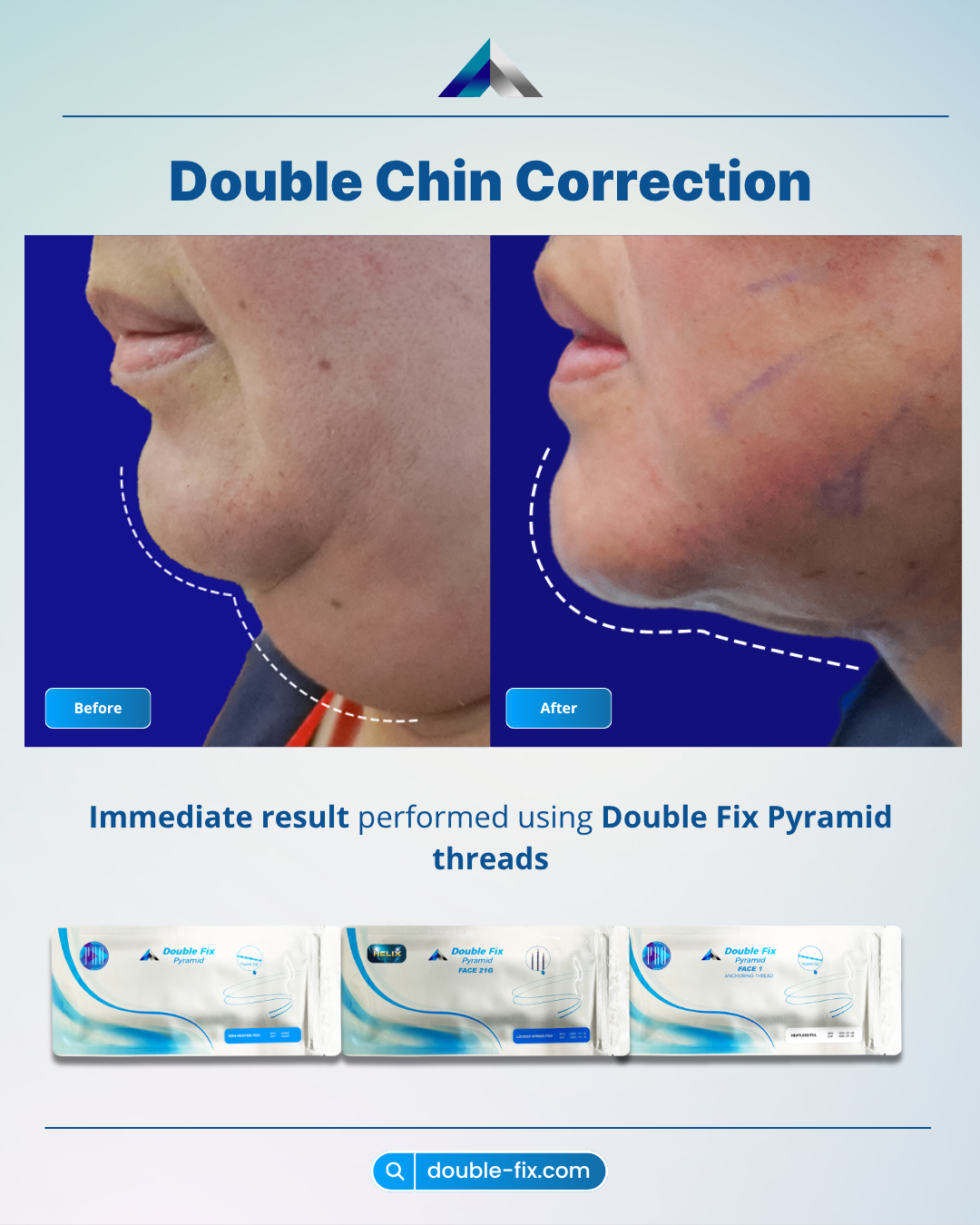 Thread Lift Jawline dan Double Chin untuk Kontur Wajah Tegas